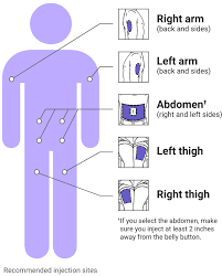 Gambar Rekomendasi tempat penyuntikan Actimmune, sumber: actimmune.com