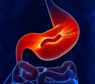Helicobacter pylori dapat menyebabkan kanker lambung. Baca penyebab kanker lainnya di asuransinow.com (sumber:medicinet.com) 