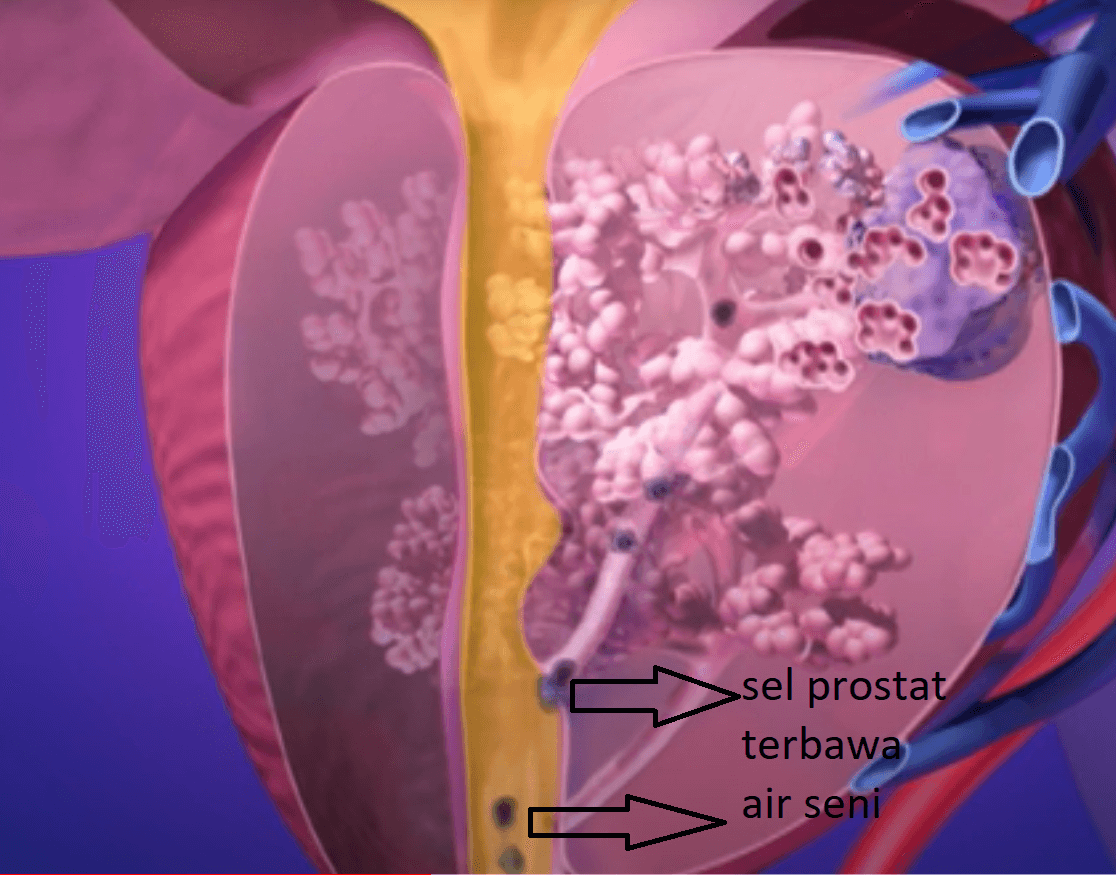 pemeriksaan psa saja tidak lengkap, lengkapi dengan tes pca3 melalui pemeriksaan colok dubur (DRE)