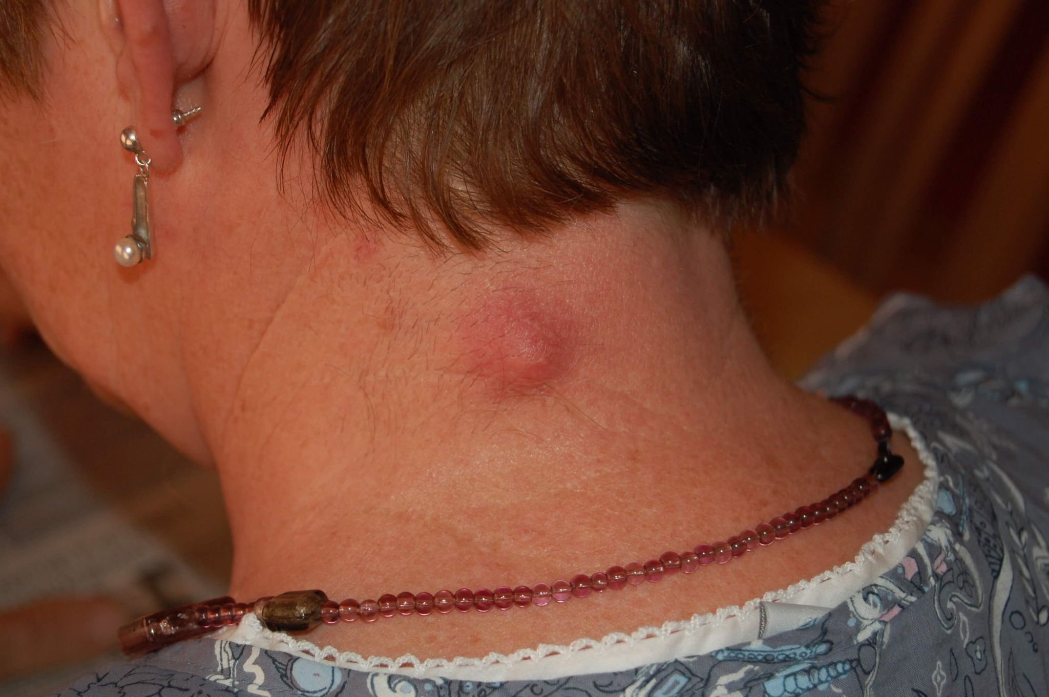 Apa Itu Lipoma? apa penyebab lipoma? - Sumber Gambar: upload.wikimedia.org