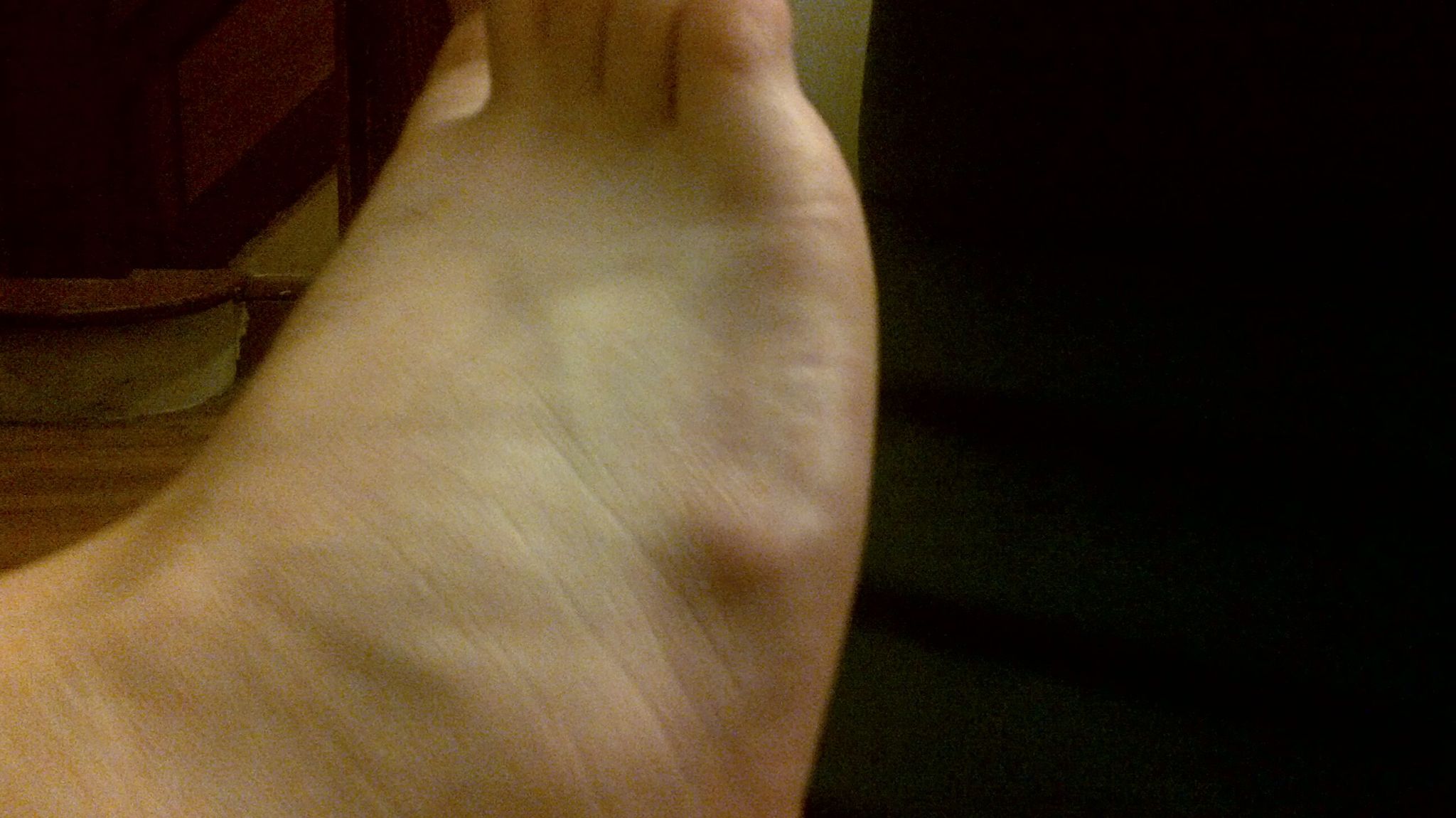 Jenis-Jenis Lipoma - Sumber Gambar: commons.wikimedia.org