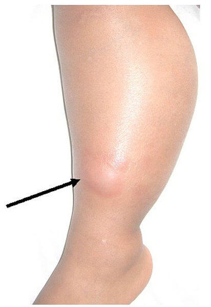 Gejala Lipoma - Sumber Gambar: commons.wikimedia.org