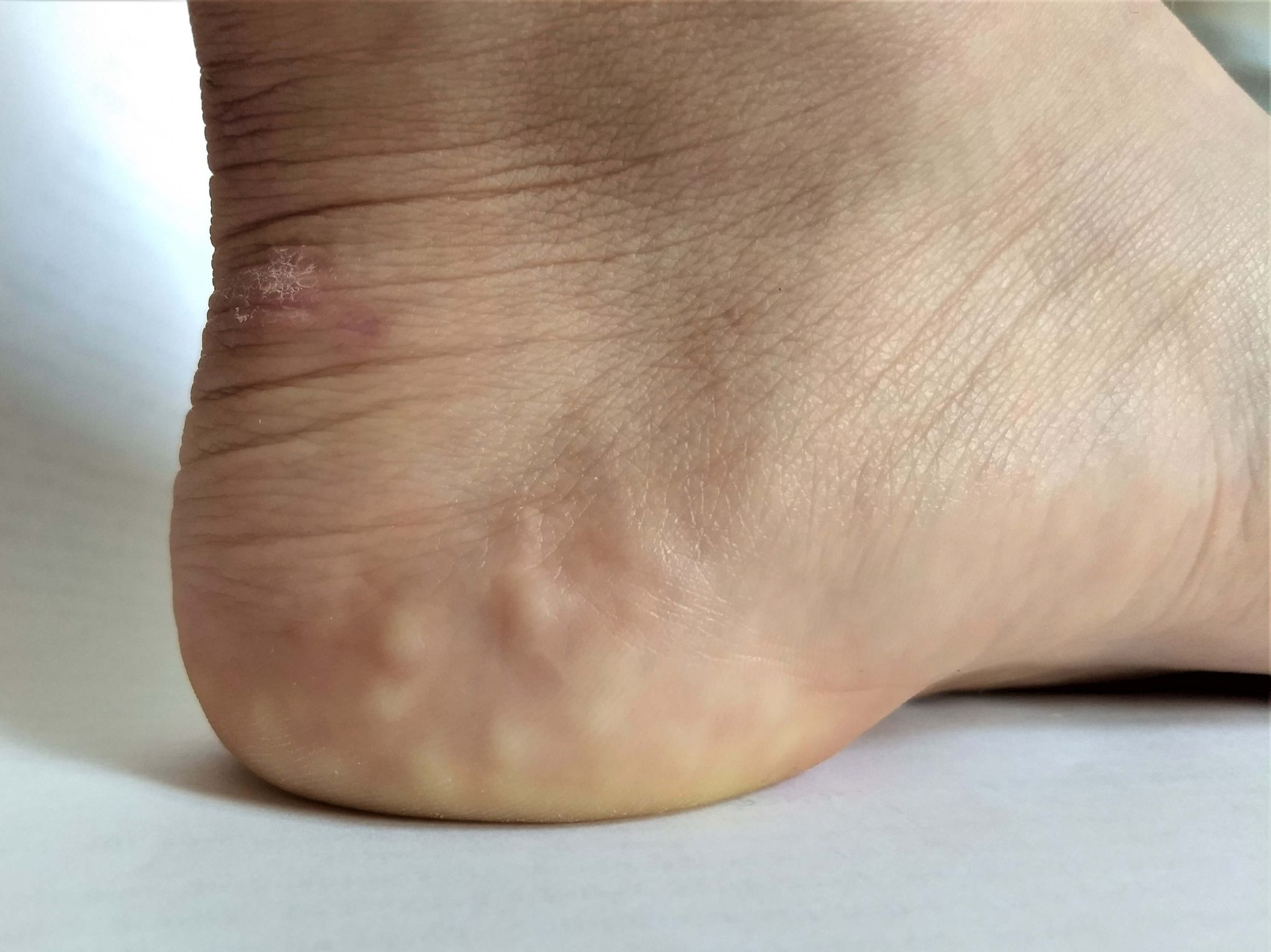 Penyebab Munculnya Lipoma - Sumber Gambar: commons.wikimedia.org